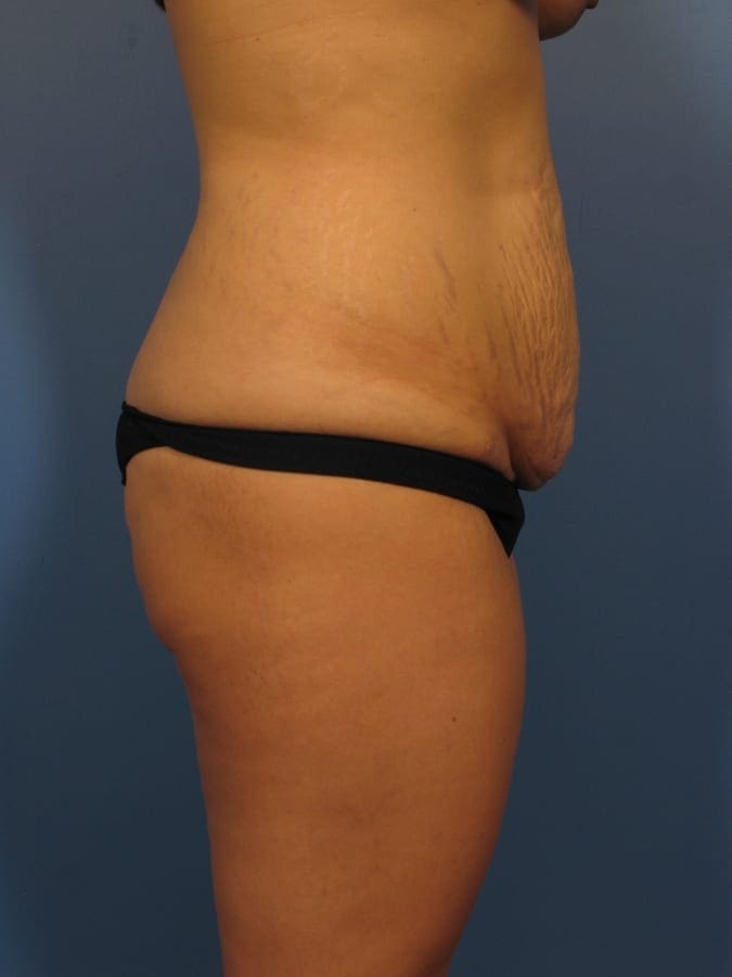 Breast Augmentation with Lift Patient Photo - Case 334 - before view-2