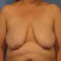 Breast Augmentation with Lift - Case 372 - Before