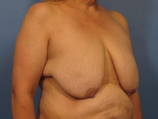 Breast Augmentation with Lift Patient Photo - Case 372 - before view-1