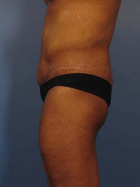 After Major Weight Loss Patient Photo - Case 325 - after view-2