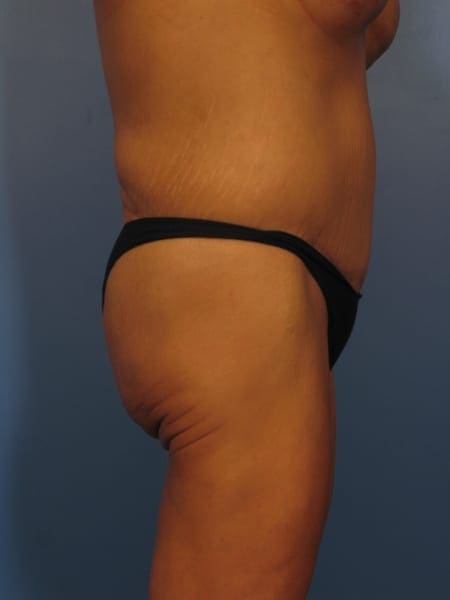 Tummy Tuck Revision Patient Photo - Case 354 - after view-1
